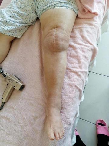 边冬香 - 案例一（調理後）