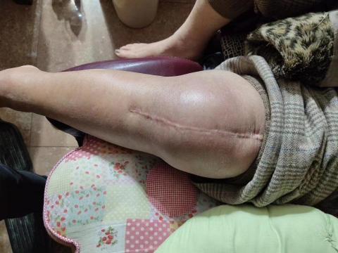 边冬香 - 案例一（調理前）