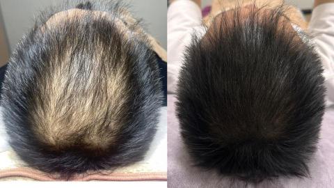 古藝眉毛藝術 - 頭皮仿毛囊紋繡