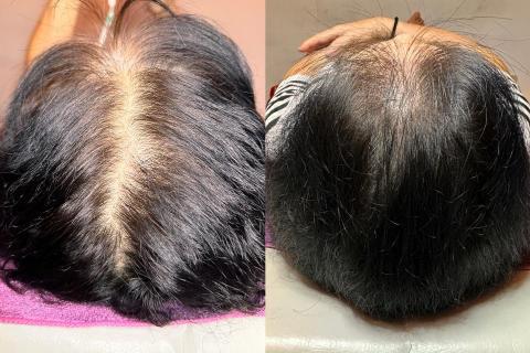 古藝眉毛藝術 - 頭皮仿毛囊紋髮