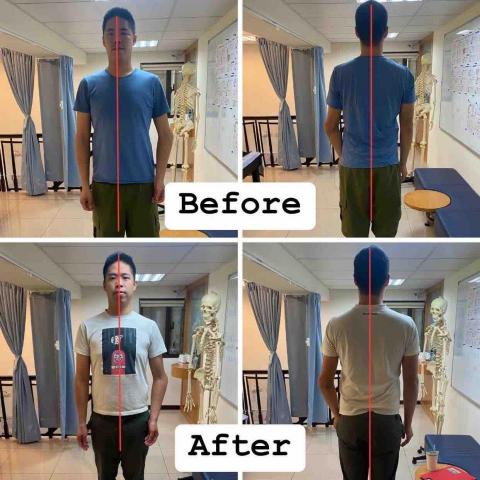 賴妤捷 - 剛接觸的時候比上圖更嚴重的歪斜，肌肉拉傷導致其他肌群代償，身體很聰明，會自己找到舒適不痛的方式支撐身體，但久了身體肌肉張力不平均，已產生歪斜！
經由評估後進行肌筋膜放鬆，密集的一週一次調整，讓身體恢復較正常的位置，腰也不疼痛了
身體構造-骨骼、肌肉、筋膜，這三個只要有一個緊繃或是壞掉，就會牽連其他地方，不是只有找痛點，相對位置也要考慮
進去
好好放鬆身體，生活、訓練沒煩惱～