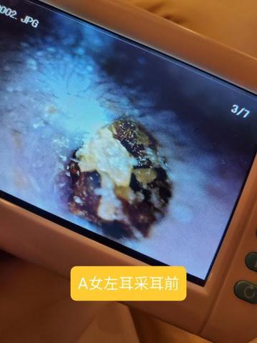 KiKi技導/美容師 - 采耳前耳道狀況 KiKi技導/美容師 - 采耳前耳道狀況