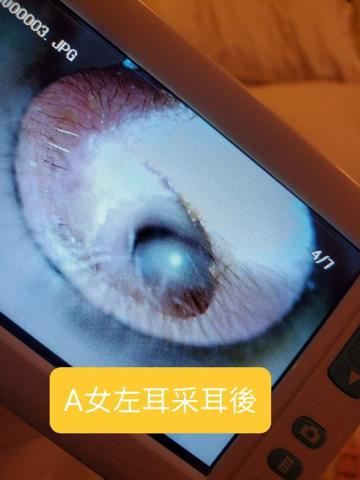 KiKi技導/美容師 - 采耳後耳道狀況
 KiKi技導/美容師 - 采耳後耳道狀況