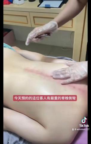 葦莛專業美學 - 脊椎側彎案例照