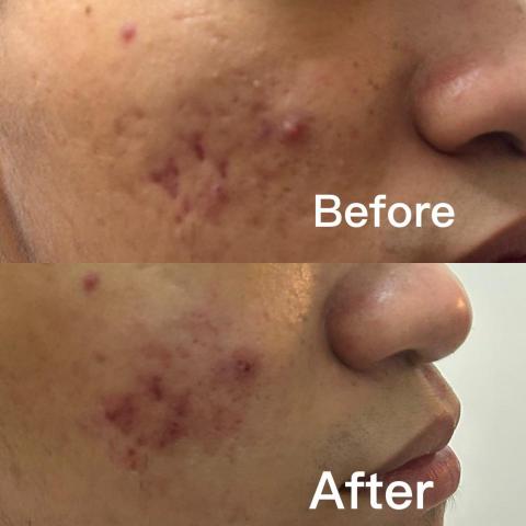 葦莛專業美學 - 嚴重痘痘肌膚案例對比照