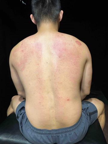 Jeff - 右側明顯較紅 加上脊椎側彎，滑罐完明顯放鬆