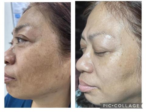 亮采美肌坊 - 活顏養膚半年的改善效果