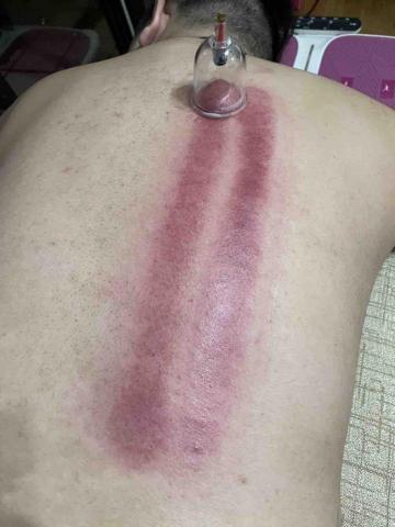 筋膜放鬆工作室 - 身體側睡氣血堵用滑罐洩氣