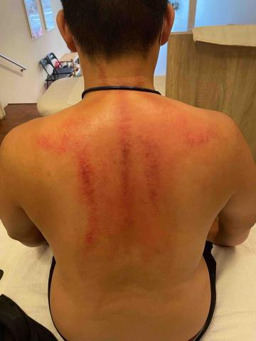 筋膜放鬆工作室 - 夏天刮痧去溼