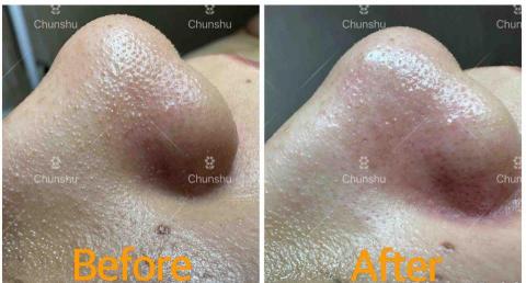 春樹美容SPA - 水飛梭前後對比