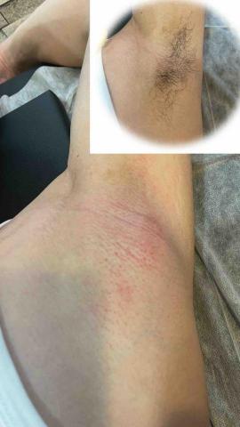 JP男性熱蠟除毛 - 腋下除毛