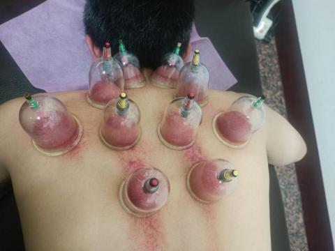 筋愛湧傳統整復推拿刮痧館 - 肩頸痠痛的拔罐處理