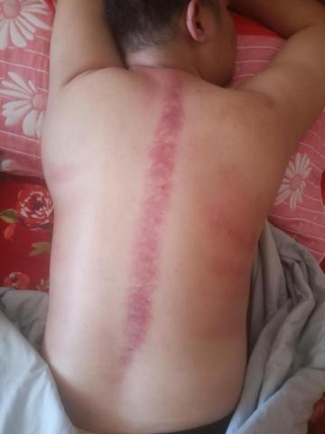 筋愛湧傳統整復推拿刮痧館 - 脊椎滑罐