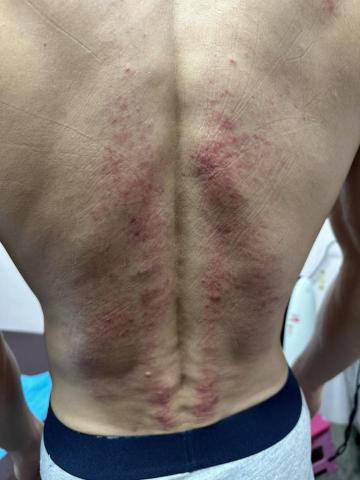 寡人有吉經絡按摩 - 1/20徒手按摩+筋膜刀放鬆，不小心就出痧冒痘了@@