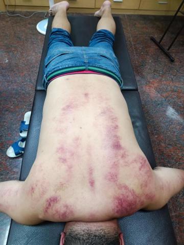 筋愛湧傳統整復推拿刮痧館 - 腰背部肌肉痠痛利用刮痧舒緩