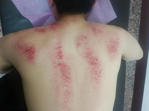 筋愛湧傳統整復推拿刮痧館 - 背部的刮痧處理