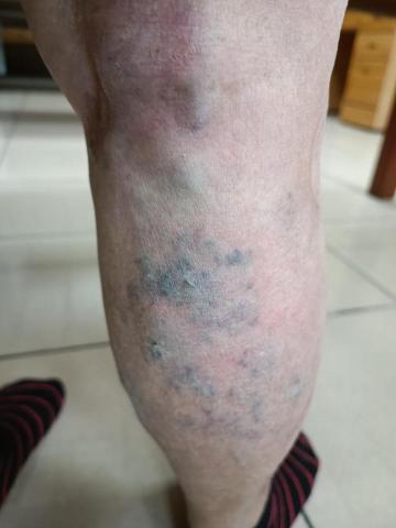 筋愛湧傳統整復推拿刮痧館 - 膝關節疼痛
利用拍打
導致出痧來緩解疼痛