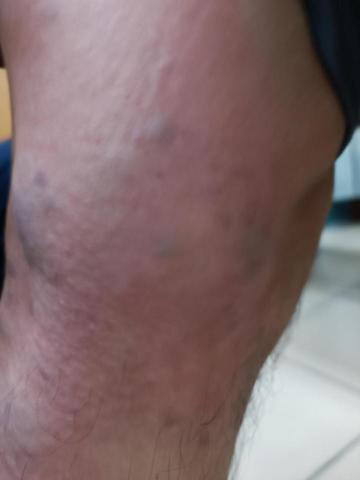 筋愛湧傳統整復推拿刮痧館 - 膝窩的拍痧