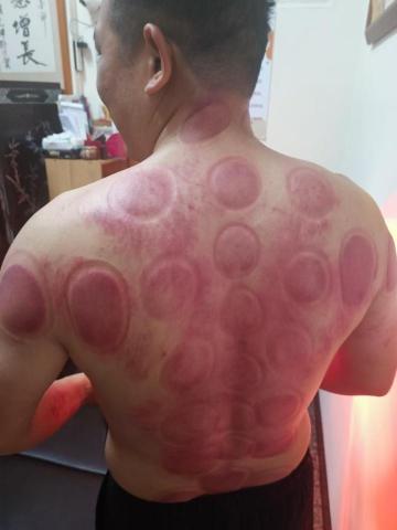 筋愛湧傳統整復推拿刮痧館 - 肩頸腰部刮痧拔罐綜合處理