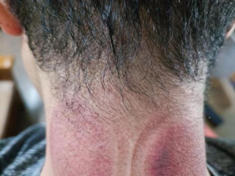 筋愛湧傳統整復推拿刮痧館 - 頸部拔罐