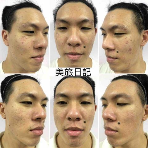 美旅日記 - 男性做臉前後對比照，粉刺痘痘凹洞油性肌膚