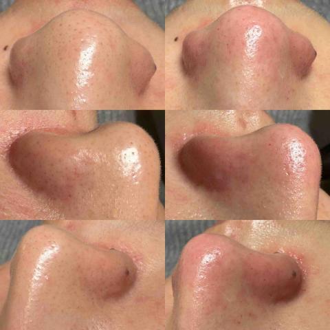 美旅日記 - 黑頭粉刺消滅