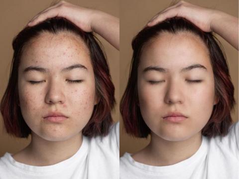 文ㄟ - 臉部基礎修復