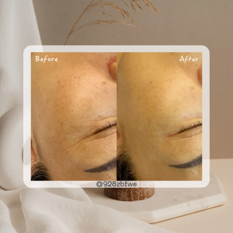 林口·洛庭 -  類醫美護膚-液態皮秒