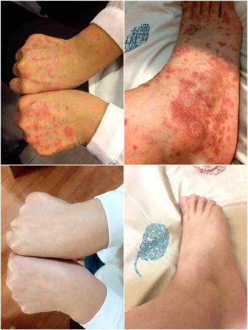 陳璵帆－依絲美妍 - 乾癬/過敏/氣喘 改善顧問