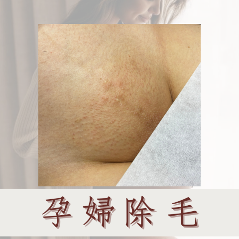 in waxing beauty在除毛 - 孕婦除毛
