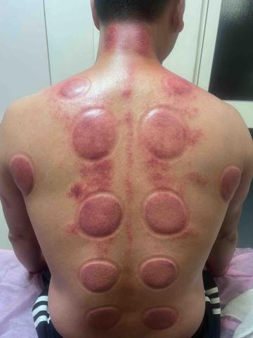 貝貝/舒壓你的背 - 刮痧/拔罐