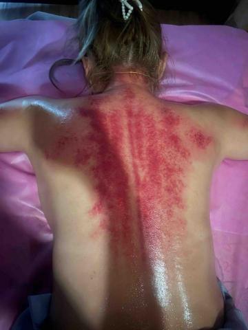 貝貝/舒壓你的背 - 客人中暑，油推完刮痧刮的紅通通