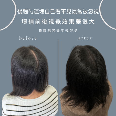 四茂紋髮|英式SMP紋髮|仿針毛囊|頭皮紋髮|落髮改善|疤痕 -  四茂紋髮|英式SMP紋髮|仿針毛囊|頭皮紋髮|落髮改善|疤痕 -
