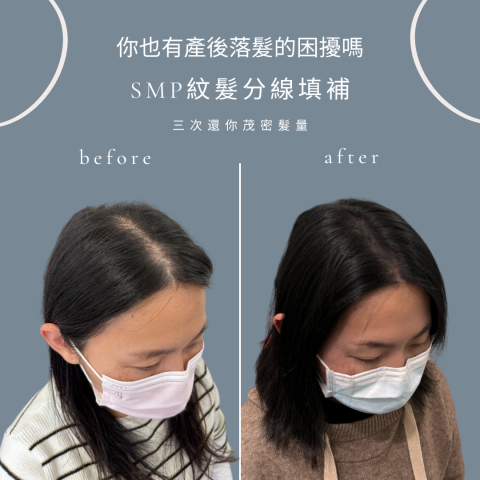 四茂紋髮|英式SMP紋髮|仿針毛囊|頭皮紋髮|落髮改善|疤痕 -  四茂紋髮|英式SMP紋髮|仿針毛囊|頭皮紋髮|落髮改善|疤痕 -