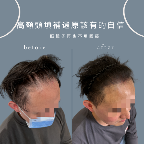 四茂紋髮|英式SMP紋髮|仿針毛囊|頭皮紋髮|落髮改善|疤痕 -  四茂紋髮|英式SMP紋髮|仿針毛囊|頭皮紋髮|落髮改善|疤痕 -