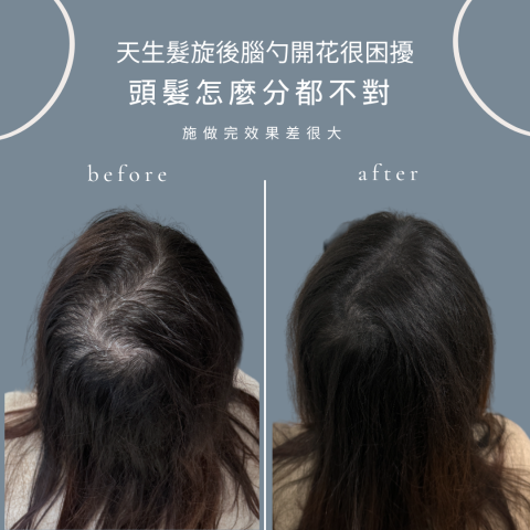 四茂紋髮|英式SMP紋髮|仿針毛囊|頭皮紋髮|落髮改善|疤痕 -  四茂紋髮|英式SMP紋髮|仿針毛囊|頭皮紋髮|落髮改善|疤痕 -
