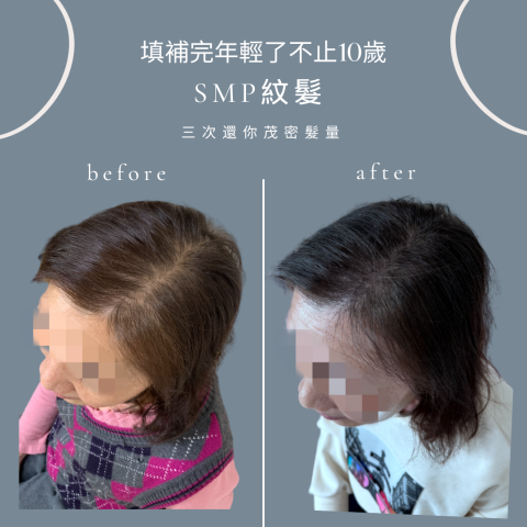 四茂紋髮|英式SMP紋髮|仿針毛囊|頭皮紋髮|落髮改善|疤痕 -  四茂紋髮|英式SMP紋髮|仿針毛囊|頭皮紋髮|落髮改善|疤痕 -