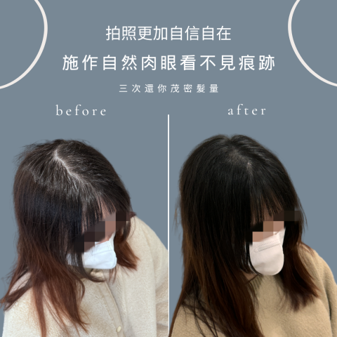 四茂紋髮|英式SMP紋髮|仿針毛囊|頭皮紋髮|落髮改善|疤痕 - 奧 四茂紋髮|英式SMP紋髮|仿針毛囊|頭皮紋髮|落髮改善|疤痕 - 奧