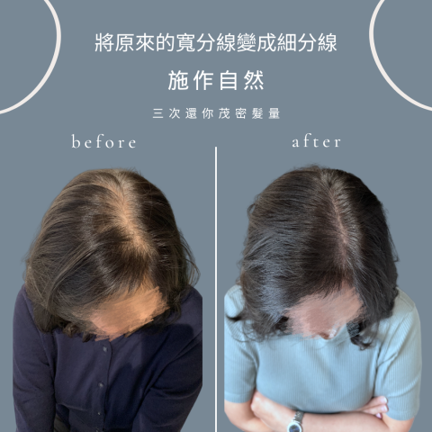 四茂紋髮|英式SMP紋髮|仿針毛囊|頭皮紋髮|落髮改善|疤痕 -  四茂紋髮|英式SMP紋髮|仿針毛囊|頭皮紋髮|落髮改善|疤痕 -