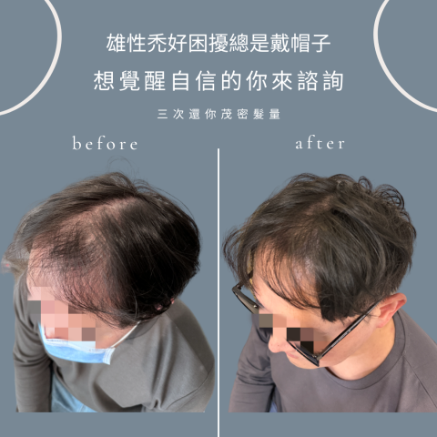 四茂紋髮|英式SMP紋髮|仿針毛囊|頭皮紋髮|落髮改善|疤痕 -  四茂紋髮|英式SMP紋髮|仿針毛囊|頭皮紋髮|落髮改善|疤痕 -