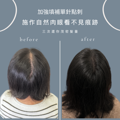 四茂紋髮|英式SMP紋髮|仿針毛囊|頭皮紋髮|落髮改善|疤痕 -  四茂紋髮|英式SMP紋髮|仿針毛囊|頭皮紋髮|落髮改善|疤痕 -
