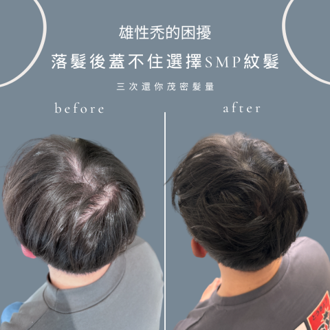 四茂紋髮|英式SMP紋髮|仿針毛囊|頭皮紋髮|落髮改善|疤痕 -  四茂紋髮|英式SMP紋髮|仿針毛囊|頭皮紋髮|落髮改善|疤痕 -