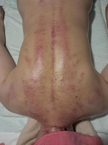 女王行動按摩 - 刮痧