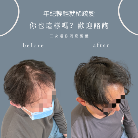 四茂紋髮|英式SMP紋髮|仿針毛囊|頭皮紋髮|落髮改善|疤痕 -  四茂紋髮|英式SMP紋髮|仿針毛囊|頭皮紋髮|落髮改善|疤痕 -