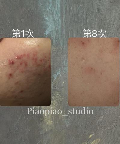 Piaopiao__studio - 皮膚管理：基本清潔、抗痘、美白、補水
有什麼需求幾乎都能解決!!
1:1私人訂製護膚課程♾️
針對個人皮膚問題配做項目