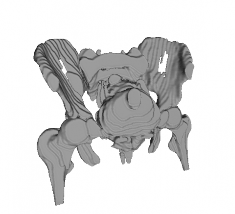 楊閔傑 - Uterine myoma MRI image reconstruction