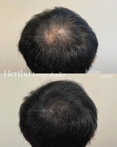 Hertha赫莎 KSMP韓國頭皮紋髮專門 - KSMP男士髮旋增密填補|두피문신 Hertha赫莎 KSMP韓國頭皮紋髮專門 - KSMP男士髮旋增密填補|두피문신