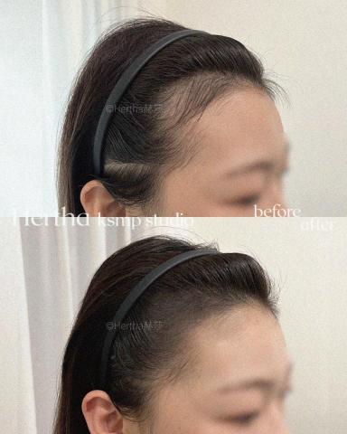 Hertha赫莎 KSMP韓國頭皮紋髮專門 - KSMP柔霧感M字額角填補|두피문신 Hertha赫莎 KSMP韓國頭皮紋髮專門 - KSMP柔霧感M字額角填補|두피문신