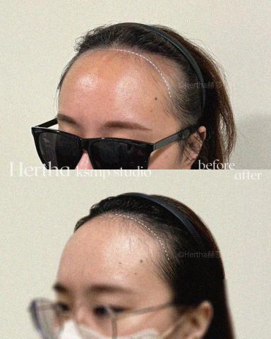 Hertha赫莎 KSMP韓國頭皮紋髮專門 - KSMP柔霧感額角髮際線|두피문신 Hertha赫莎 KSMP韓國頭皮紋髮專門 - KSMP柔霧感額角髮際線|두피문신