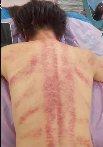 黃莉樺 - 美療師真心提醒給顧客的話:

當我們的身體受到疲勞和壓力的影響時，經絡按摩可以

幫助我們恢復能量和活力。肩膀僵硬、頭痛、失眠 

不適症狀.都可以透過經絡按摩可以得到緩解.讓身體

得到充分的休息和修復. 當身體充滿活力與能量皮膚跟

體態才能展現更好的狀態，讓我們外表美麗和內在健康

做出完美地結合。  {顧客享受油壓刮痧後作品}

